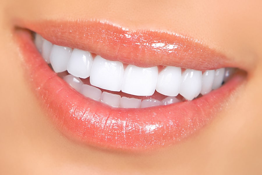 Veneers Veneers